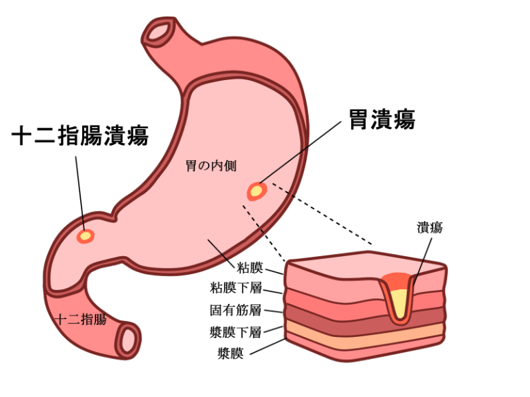 胃潰瘍とは