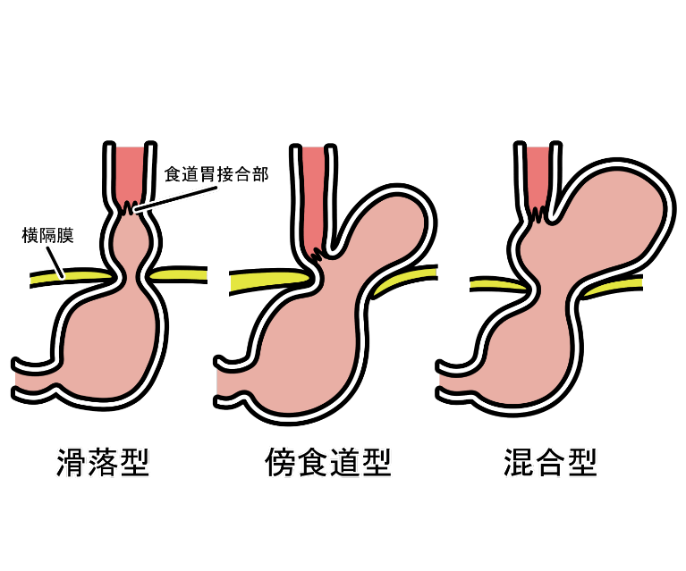 食道裂孔ヘルニアの種類
