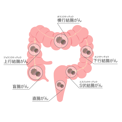 大腸がんとは