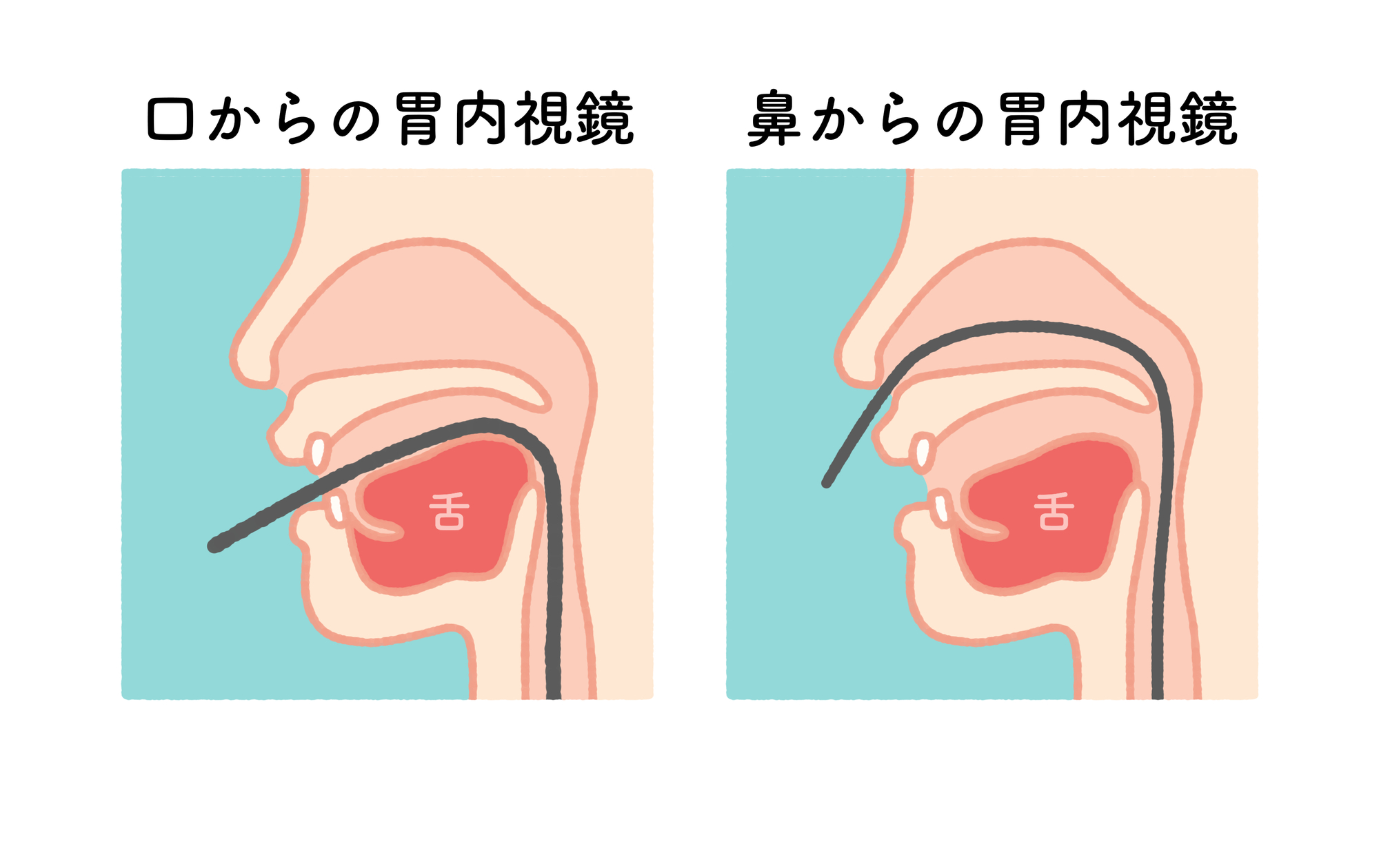 経鼻･経口から選べる胃カメラ