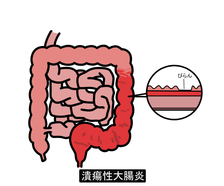 潰瘍性大腸炎