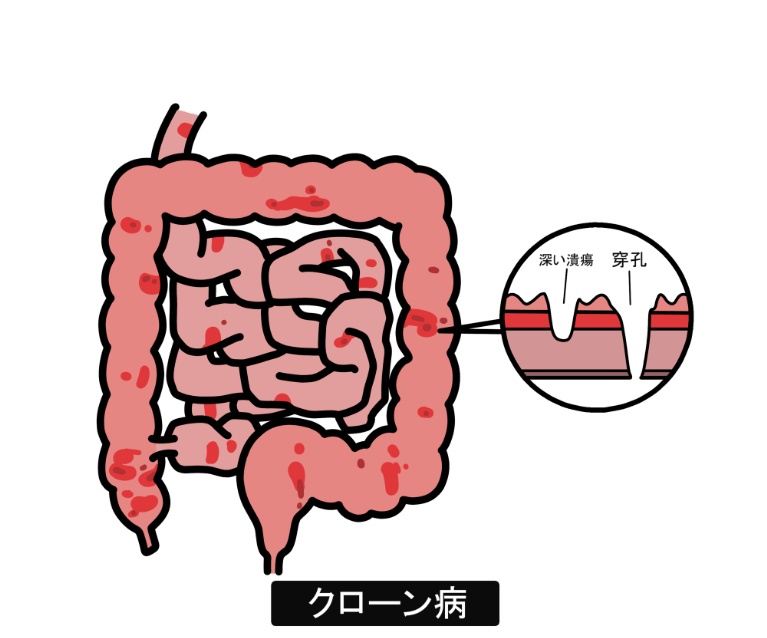 クローン病