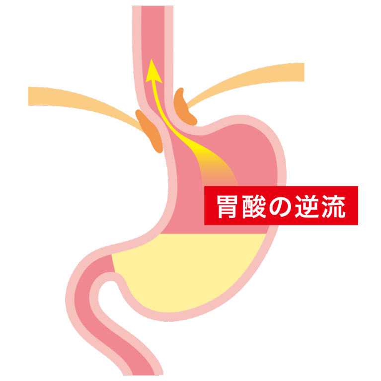 逆流性食道炎